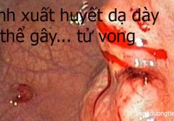 Chữa xuất huyết dạ dày