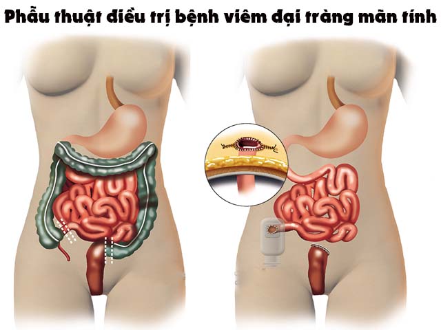 Điều trị viêm đại tràng mãn tính