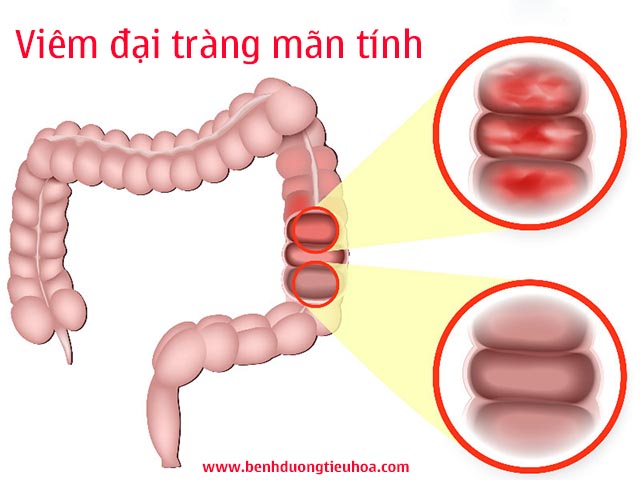 Bệnh viêm đại tràng mãn tính