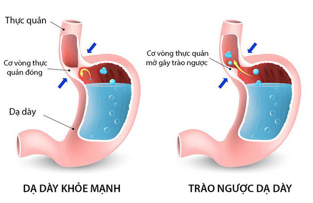 triệu chứng trào ngược dạ dày thường gặp