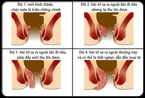 Bệnh trĩ nội được chia thành 4 độ dựa vào độ sa của búi trĩ