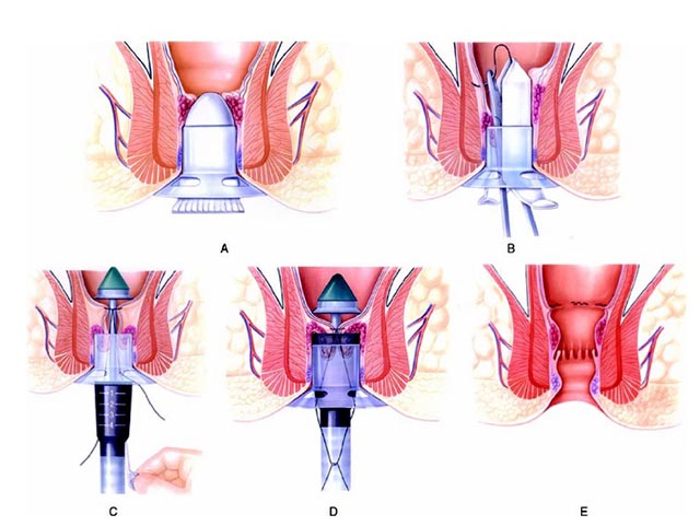 Cách chữa bệnh trĩ nội độ 4 bằng PPH