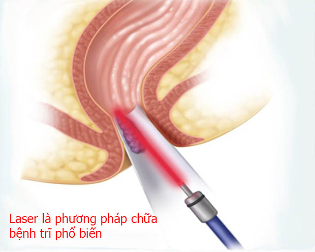 Chữa trĩ nội độ 4 bằng laser