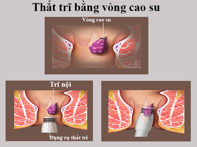 Điều trị bệnh trĩ