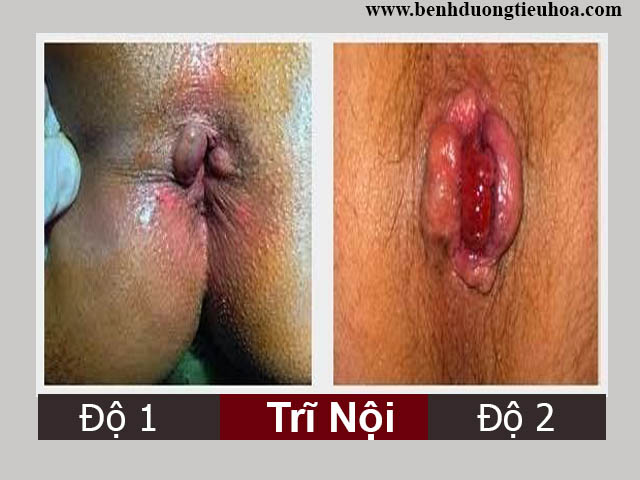 Bệnh trĩ nội độ 1 và 2