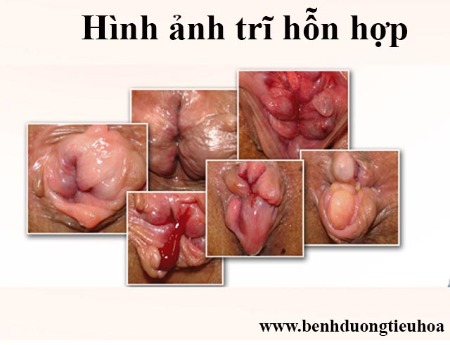 Hình ảnh trĩ hỗn hợp