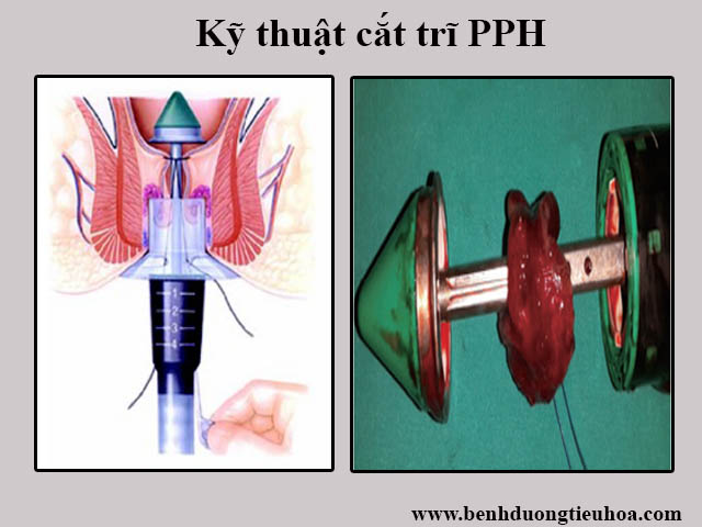 Cách chữa bệnh trĩ