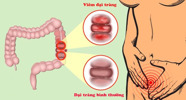 Triệu chứng viêm đại tràng