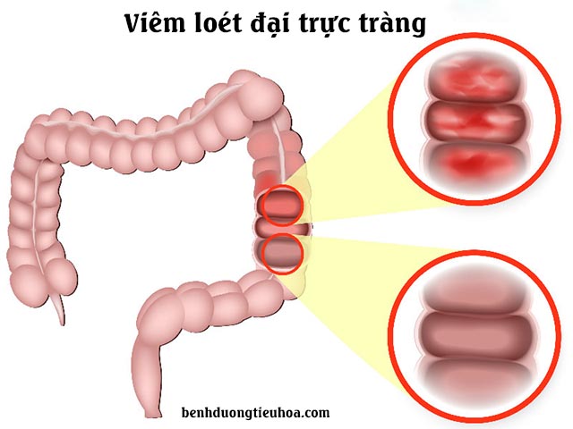 Đi vệ sinh ra máu tươi