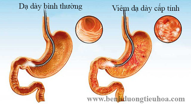 Chẩn đoán viêm dạ dày cấp tính