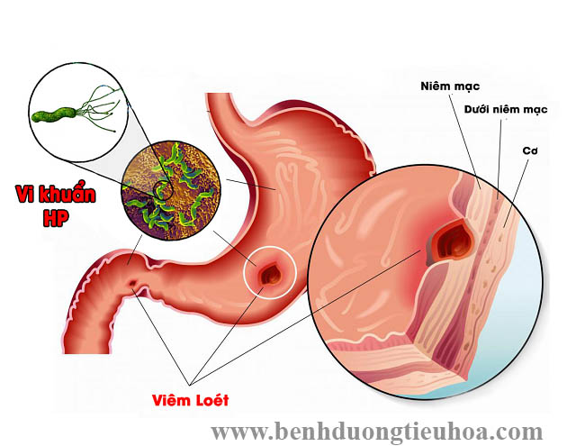 Nguyên nhân và triệu chứng viêm dạ dày cấp tính