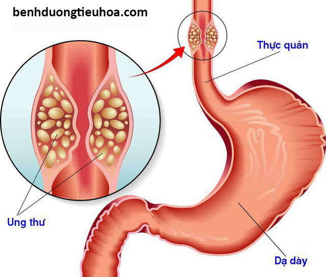 Hình ảnh giải phẫu bệnh ung thư thực quản