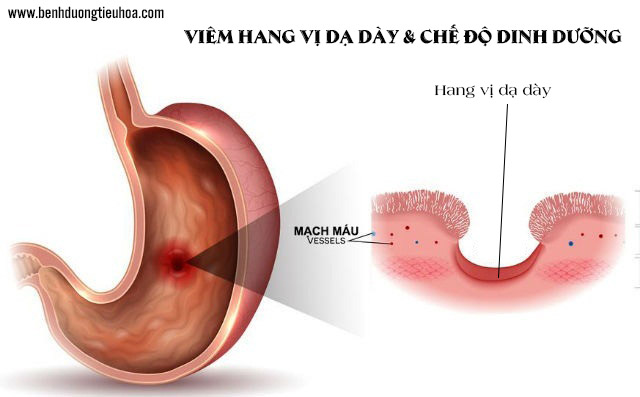 Bị viêm loét hang vị dạ dày nên ăn gì, kiêng gì?