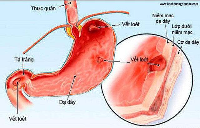 Thuốc chữa viêm khớp có thể gây đau dạ dày