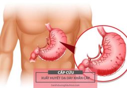 hướng dẫn cấp cứu người bị xuất huyết dạ dày