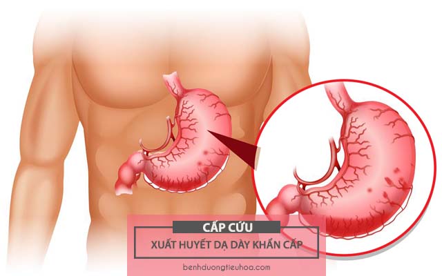 hướng dẫn cấp cứu người bị xuất huyết dạ dày