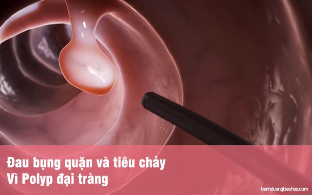 đau bụng tiêu chảy vì Polyp đại tràng