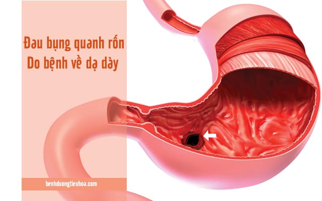 đau dạ dày gây đau quặn xung quanh rốn