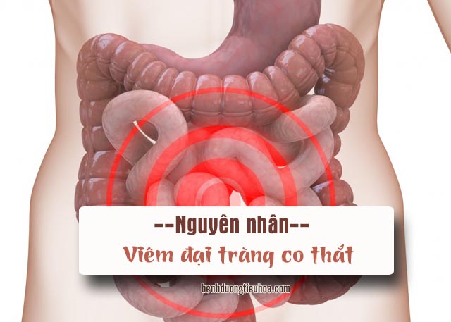 nguyên nhân gây bệnh viêm đại tràng co thắt