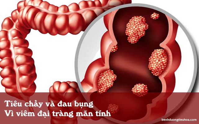 tiêu chảy do viêm đại tràng mãn tính