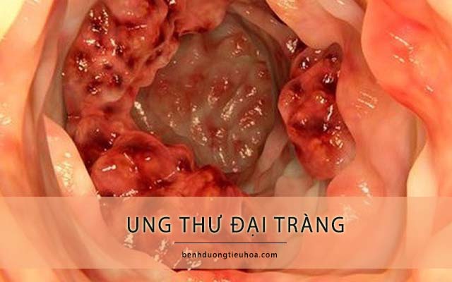 đi ngoài lúc táo lcú lỏng do ung thư đại tràng