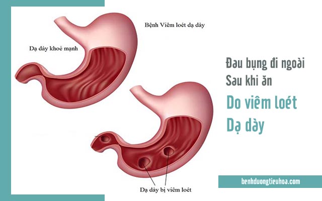 đau bụng đi ngoài sau khi ăn do viêm loét dạ dày