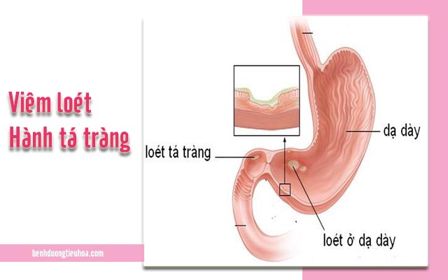 viêm loét hành tá tràng khiến đau dạ dày khi đói