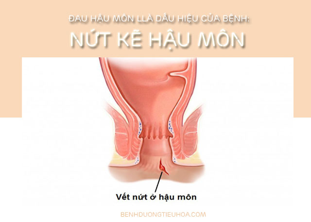 đau rát hậu môn là bị gì