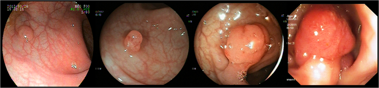 Polyp trực tràng 