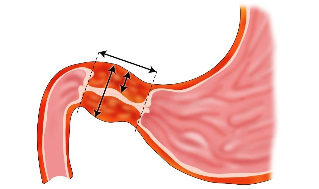 Hình ảnh hẹp môn vị dạ dày.
