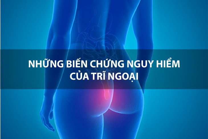 Không nên chủ quan khi bị trĩ vì dễ dẫn đến những biến chứng nguy hiểm