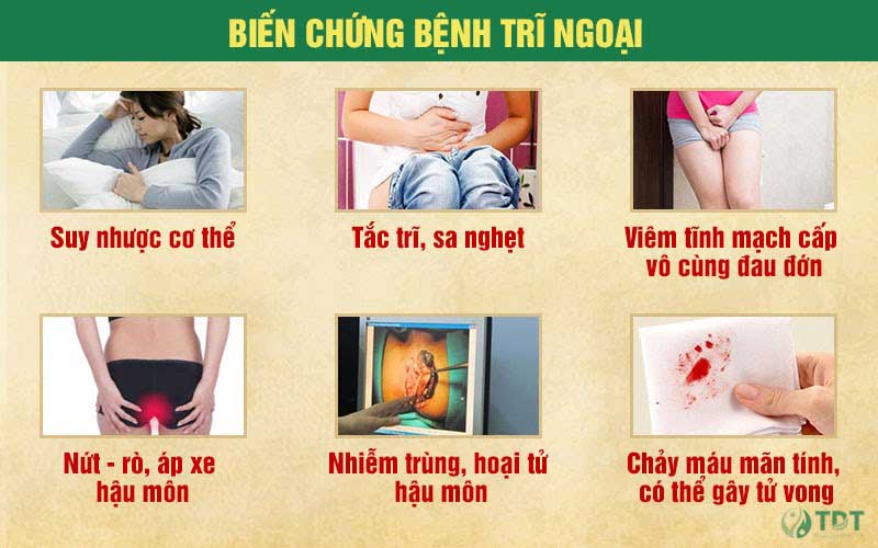 Những biến chứng nguy hiểm của trĩ ngoại mà nhiều người không ngờ đến