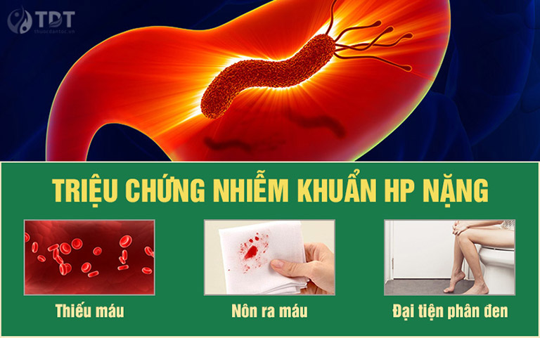 Triệu chứng nặng cảnh báo bạn đang mắc viêm dạ dày HP nặng